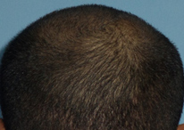 Healed donor area after FUE extraction in a hair transplant client