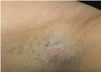 Healed area after body hair extraction