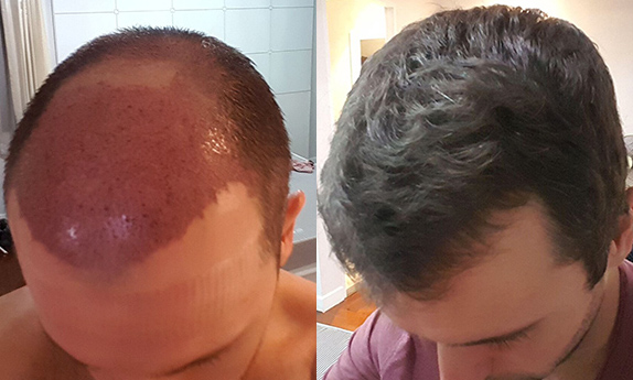 Man after growth from hair transplant surgery in Delhi