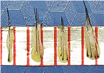 Follicular units after dissection showing 1,2,3 & 4 hair roots respectively