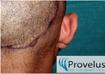Hair Transplant Donor area trimmed for FUE harvest