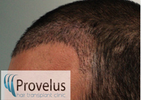 Implanted FUE hair follicles showing new hair line