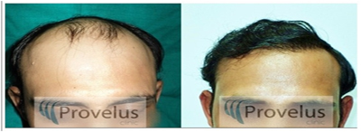 Scalp hair Transplant in Delhi